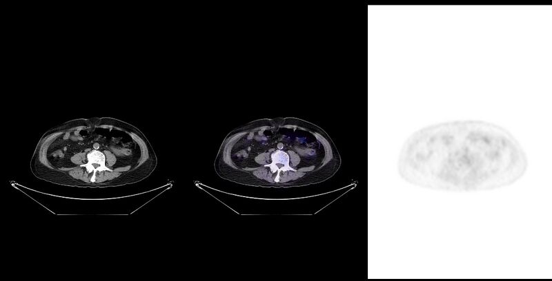 File:Non-Hodgkin lymphoma involving seminal vesicles with development of interstitial pneumonitis during Rituximab therapy (Radiopaedia 32703-33761 ax CT Fus PET 42).jpg