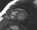 Non-compaction of the left ventricle (Radiopaedia 69436-79314 Short axis cine 69).jpg