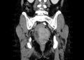 Non-puerperal uterine inversion (Radiopaedia 78343-91094 B 40).jpg
