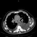 Non Hodgkin lymphoma in a patient with ankylosing spondylitis (Radiopaedia 84323-99621 Axial non-contrast 14).jpg
