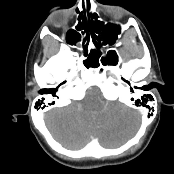 File:Normal CT of the neck (Radiopaedia 14575-14500 Axial C+ 12).jpg