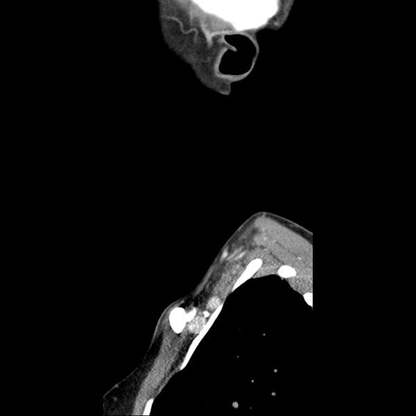 File:Normal CT of the neck (Radiopaedia 14575-14500 Sagittal C+ 49).jpg