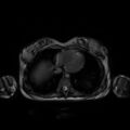 Normal MRI abdomen in pregnancy (Radiopaedia 88001-104541 Axial Gradient Echo 2).jpg