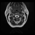 Normal cervical and thoracic spine MRI (Radiopaedia 35630-37156 Axial T2 25).png