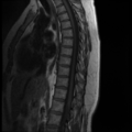 Normal cervical and thoracic spine MRI (Radiopaedia 35630-37156 I 7).png