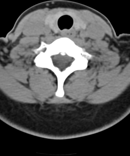 File:Normal cervical spine MRI (including Dixon) (Radiopaedia 42762-45926 Axial non-contrast 44).png