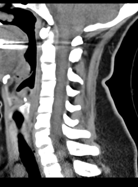File:Normal cervical spine MRI (including Dixon) (Radiopaedia 42762-45926 C 34).png