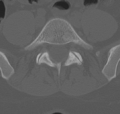 Normal lumbar spine CT (Radiopaedia 46533-50986 Axial bone window 60).png