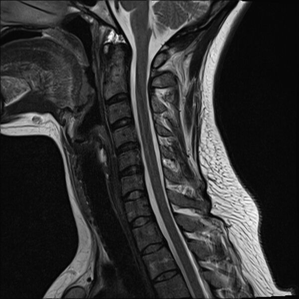 File:Normal trauma cervical spine MRI (Radiopaedia 32130-33071 Sagittal T2 8).jpg