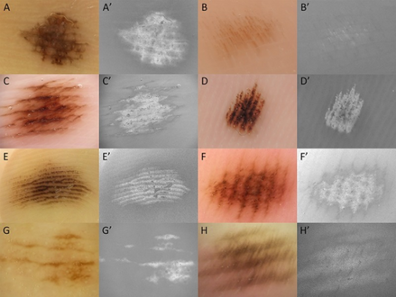 a-h)Saturation images -parallel furrow patterns or fibrillar patterns in acral nevi