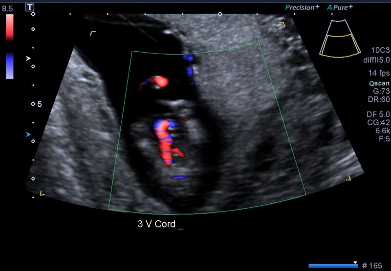 File:1st trimester nuchal-morphology ultrasound (Radiopaedia 44706-48477 General anatomy and NT 45).jpg