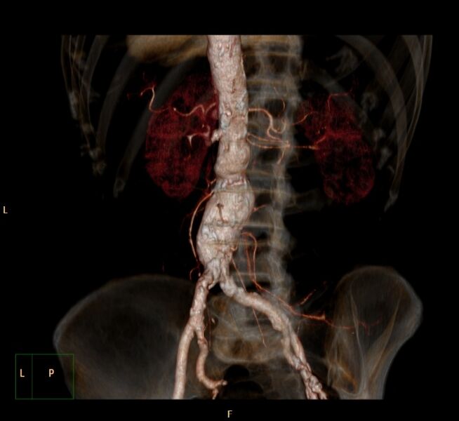 File:Abdominal aortic aneurysm (Radiopaedia 23703-23856 3D 15).jpg
