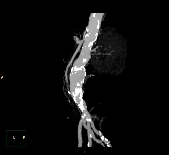 File:Abdominal aortic aneurysm (Radiopaedia 23703-23856 MIP 19).jpg