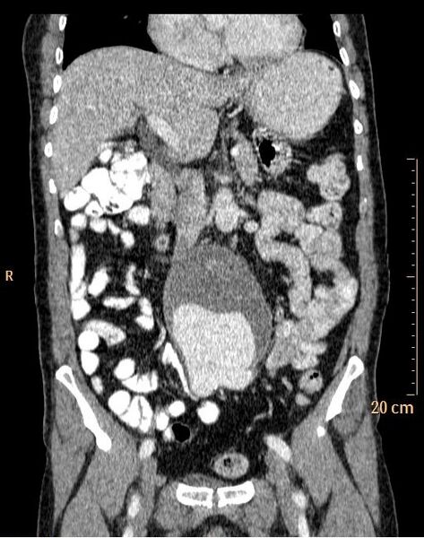 File:Abdominal aortic aneurysm (Radiopaedia 25985-26121 Coronal C+ arterial phase 15).jpg
