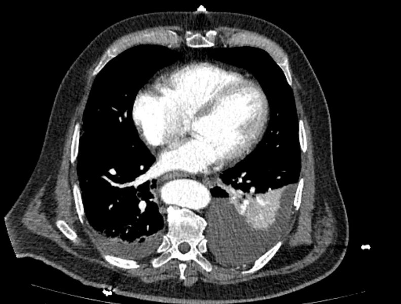 File:Abdominal aortic aneurysm rupture (Radiopaedia 54179-60362 Axial C+ arterial phase 14).jpg