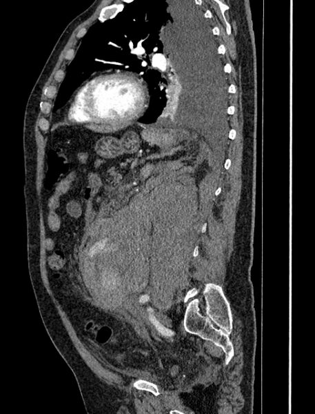 File:Abdominal aortic aneurysm rupture (Radiopaedia 54179-60362 Sagittal C+ arterial phase 28).jpg
