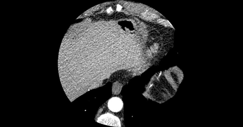 File:Aberrant left main coronary artery (ALMCA) arising from the right sinus with interarterial course (Radiopaedia 63251-71814 Axial C+ arterial phase 188).JPG