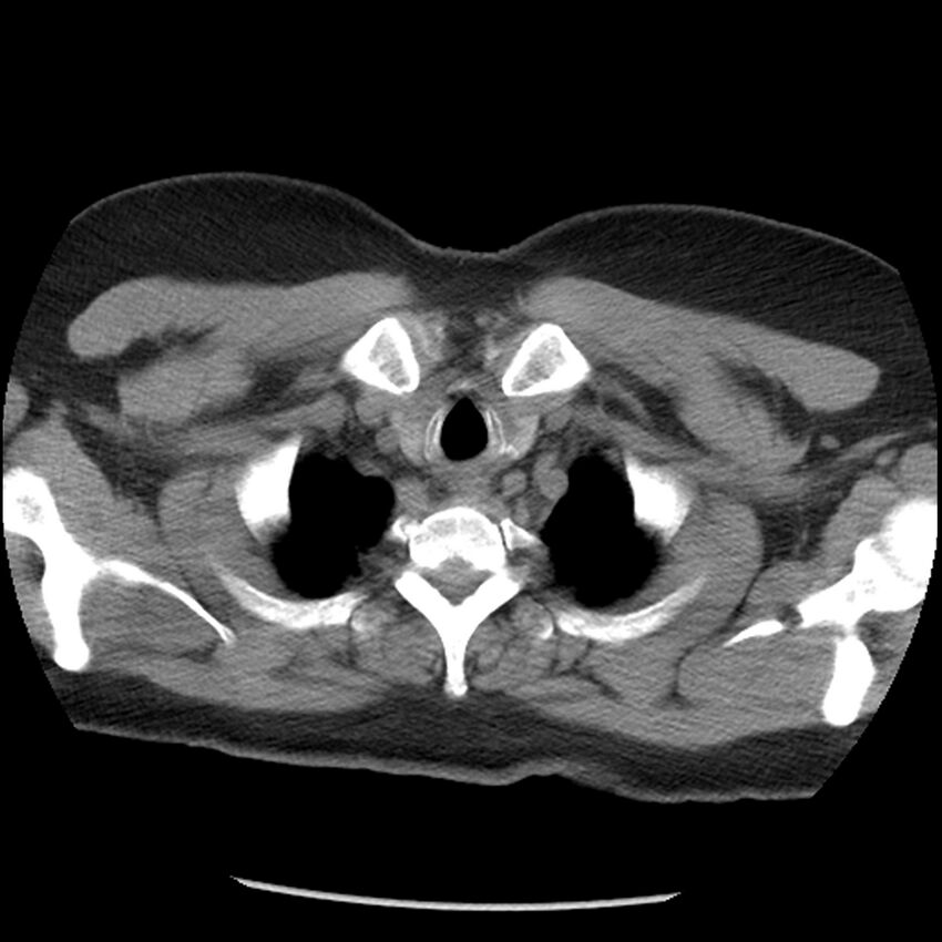 Aberrant right subclavian artery (Radiopaedia 40967-43680 Axial non-contrast 4).jpg