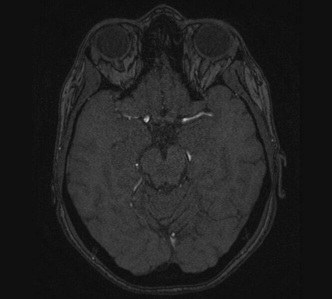 File:Accessory middle cerebral artery and ICA aneurysm (Radiopaedia 22656-22674 MRA 45).jpg
