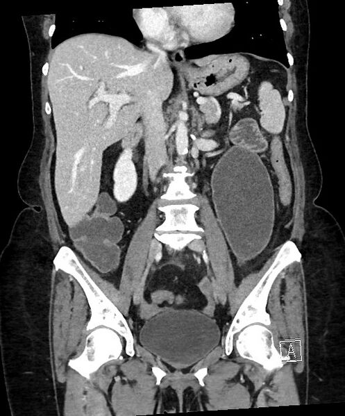 File:Active Crohn disease (Radiopaedia 59394-66750 Coronal C+ portal venous phase 39).jpg