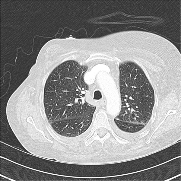 File:Acute-on-chronic pulmonary emboli (Radiopaedia 27925-28169 lung window 15).jpg