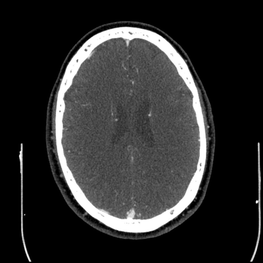 Acute A3 occlusion with ACA ischemic penumbra (CT perfusion) (Radiopaedia 72036-82527 Axial C+ arterial phase thins 31).jpg