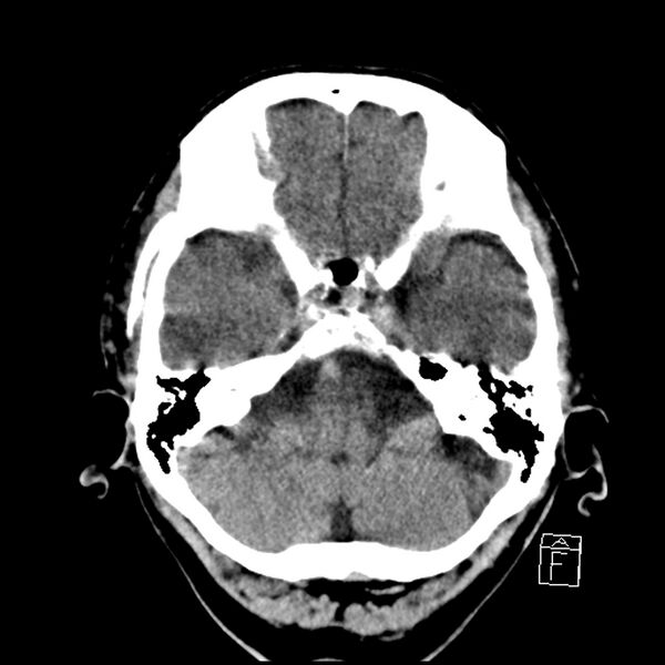 File:Acute P1 occlusion with PCA ischemia penumbra (CT perfusion) (Radiopaedia 72084-82586 Axial non-contrast 9).jpg