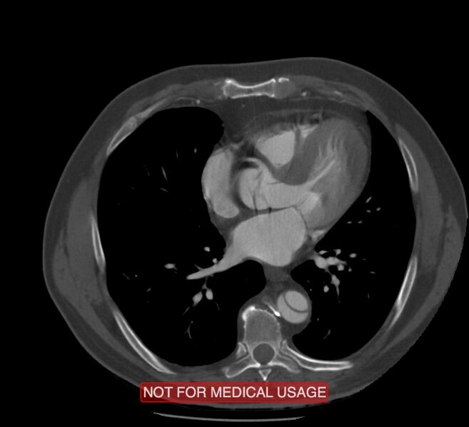 File:Acute aortic dissection - Stanford type A (Radiopaedia 40661-43285 Axial C+ arterial phase 42).jpg