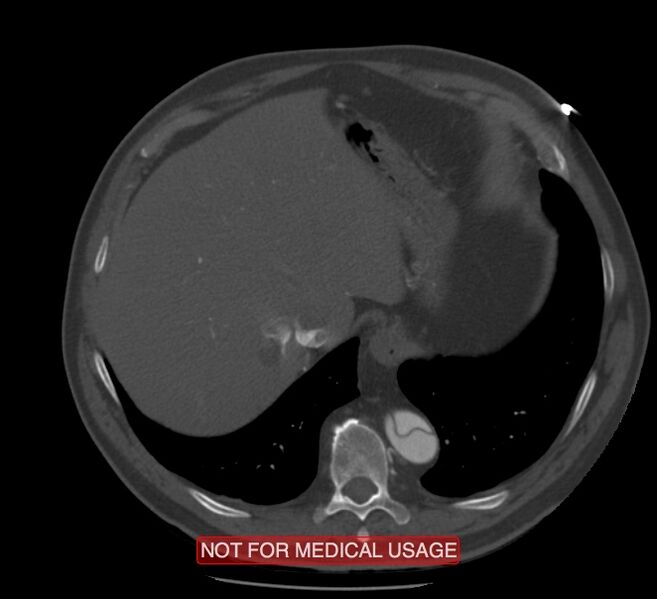 File:Acute aortic dissection - Stanford type A (Radiopaedia 40661-43285 Axial C+ arterial phase 66).jpg