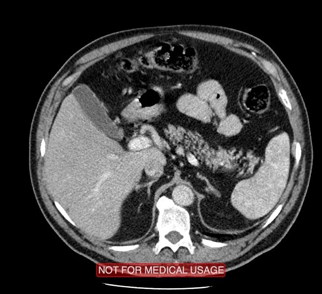 File:Acute aortic dissection - Stanford type A (Radiopaedia 40661-43285 Axial C+ portal venous phase 76).jpg