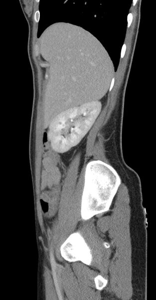 File:Acute appendicitis (Radiopaedia 62608-70901 Sagittal C+ portal venous phase 46).jpg