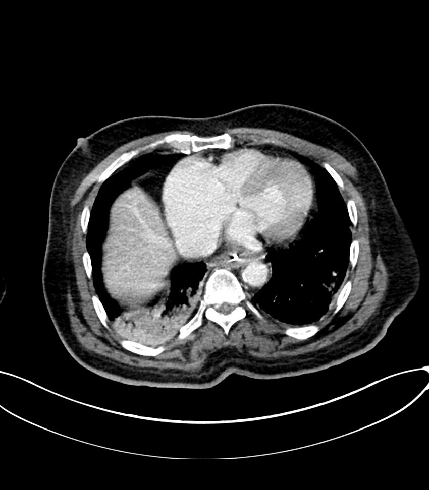 Acute arterial mesenteric ischemia (Radiopaedia 78238-90828 Axial C+ portal venous phase 14).jpg
