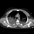 Acute aspiration pneumonitis (Radiopaedia 33605-34703 Axial non-contrast 35).jpg