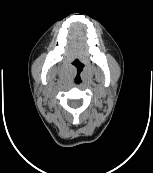 File:Acute bacterial tonsillitis (Radiopaedia 22882-22908 Axial non-contrast 18).png