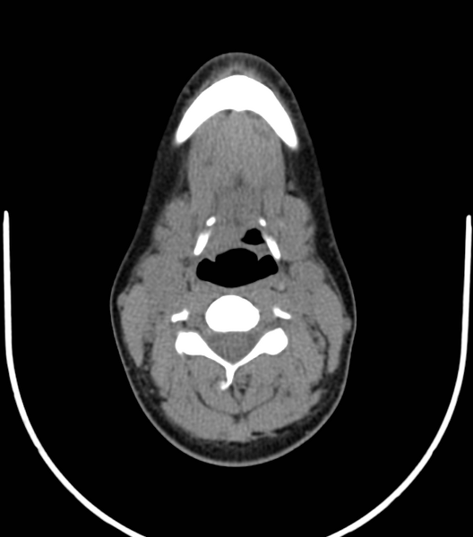 File:Acute bacterial tonsillitis (Radiopaedia 22882-22908 Axial non-contrast 32).png