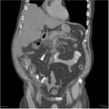 Acute pancreatitis (Radiopaedia 19135-19116 Coronal non-contrast 14).jpg
