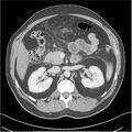 Acute pancreatitis - mild (Radiopaedia 27796-28033 C+ portal venous phase 15).jpg