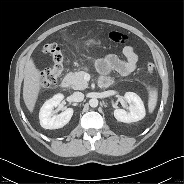 File:Acute pancreatitis - mild (Radiopaedia 27796-28033 C+ portal venous phase 15).jpg