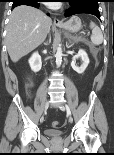 File:Acute pancreatitis complicated by portal vein thrombus (Radiopaedia 48148-52990 Coronal C+ portal venous phase 38).png