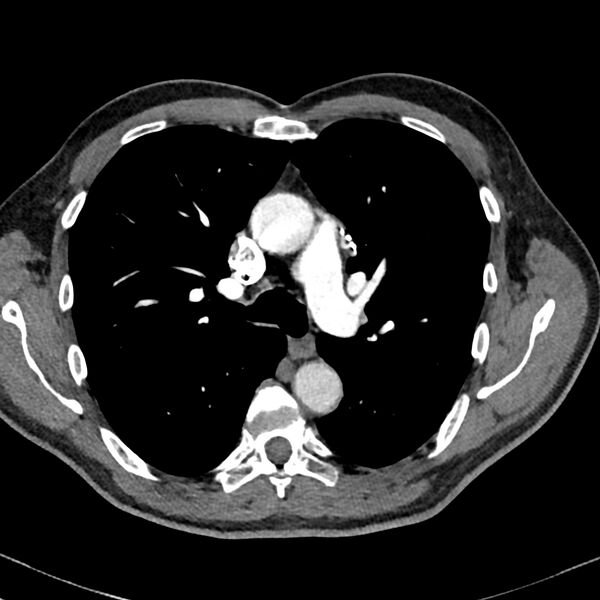 File:Acute pulmonary embolism (Radiopaedia 81677-95570 Axial C+ CTPA 33).jpg