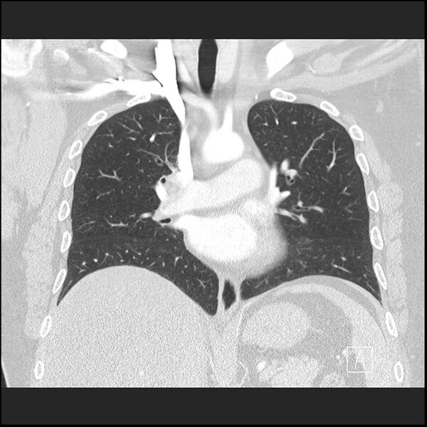 File:Acute pulmonary embolism with pulmonary infarct (Radiopaedia 73062-83768 Coronal lung window 39).jpg