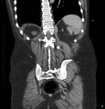 Acute renal failure post IV contrast injection- CT findings (Radiopaedia 47815-52559 Coronal C+ portal venous phase 30).jpg