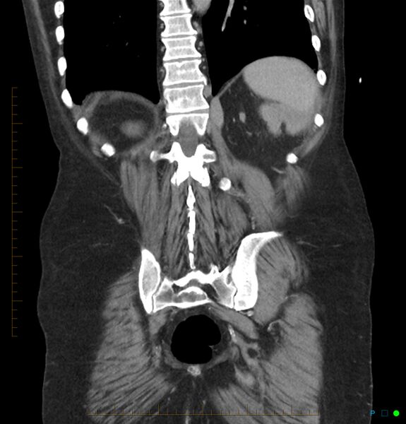 File:Acute renal failure post IV contrast injection- CT findings (Radiopaedia 47815-52559 Coronal C+ portal venous phase 30).jpg