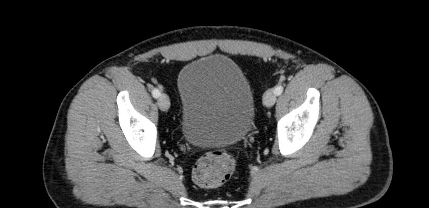 Acute sigmoid colon diverticulitis (Radiopaedia 55507-61976 Axial C+ portal venous phase 102).jpg