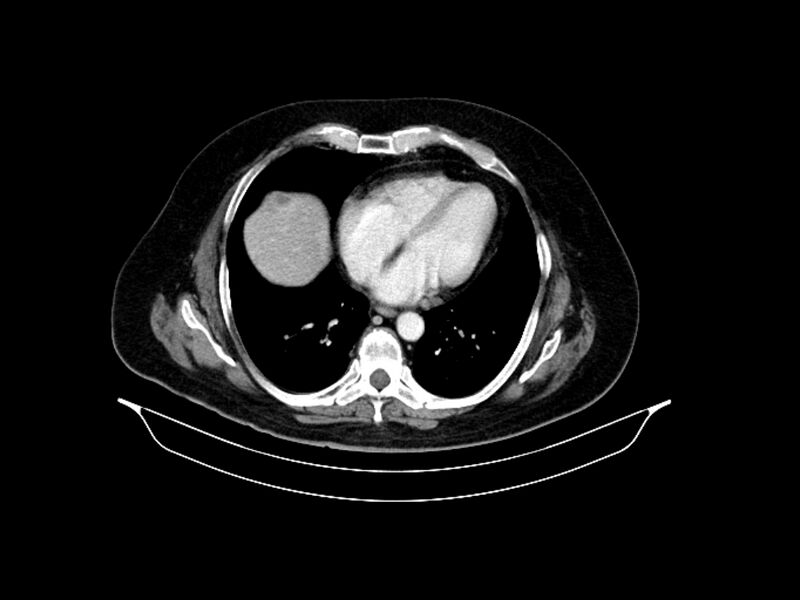 File:Adenocarcinoma of pancreas with hepatic metastasis (Radiopaedia 64332-73122 Axial C+ portal venous phase 11).jpg
