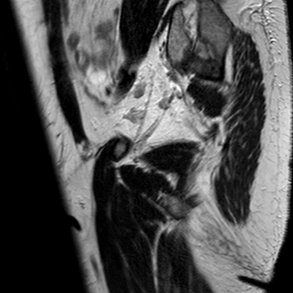 File:Adenomyoma of the uterus (Radiopaedia 9871-10439 Sagittal T2 23).jpg