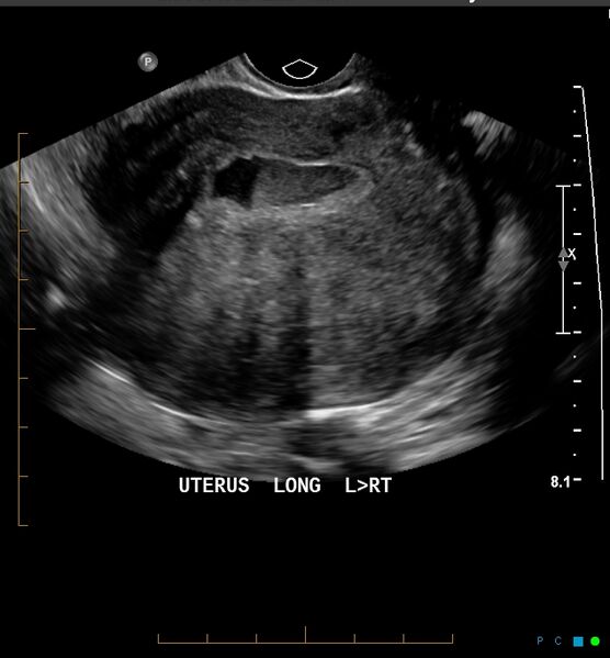 File:Adenomyosis uterus with hematometra (Radiopaedia 45779-51705 Longitudinal 1).jpg