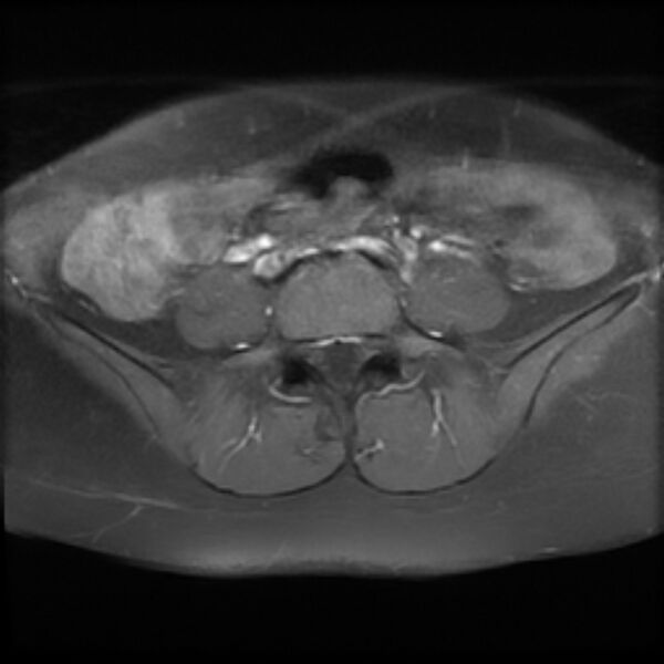 File:Adenomyosis within a septate uterus (Radiopaedia 69963-79981 Axial T1 C+ fat sat 2).jpg