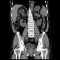 Adrenal myelolipoma (Radiopaedia 41843-44834 Coronal non-contrast 10).jpg