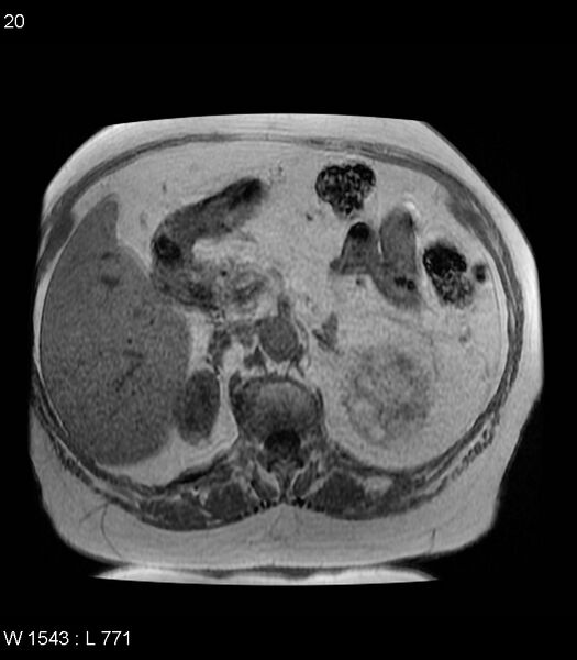 File:Adrenal myelolipoma (Radiopaedia 6765-7961 Axial T1 in-phase 20).jpg
